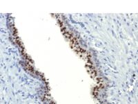 Formalin-fixed, paraffin-embedded human Prostate Carcinoma stained with FOXA1 Monoclonal Antibody (FOXA1/1514).