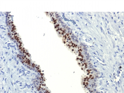 Formalin-fixed, paraffin-embedded human Prostate Carcinoma stained with FOXA1 Monoclonal Antibody (FOXA1/1514).