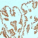 Formalin-fixed, paraffin-embedded human Prostate Carcinoma stained with FOXA1 Monoclonal Antibody (FOXA1/1515).