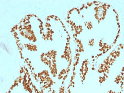 Formalin-fixed, paraffin-embedded human Prostate Carcinoma stained with FOXA1 Monoclonal Antibody (FOXA1/1515).