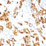 Formalin-fixed, paraffin-embedded human Prostate Carcinoma stained with HSP27 Monoclonal Antibody (HSPB1/774)