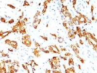 Formalin-fixed, paraffin-embedded human Prostate Carcinoma stained with HSP27 Monoclonal Antibody (HSPB1/774)