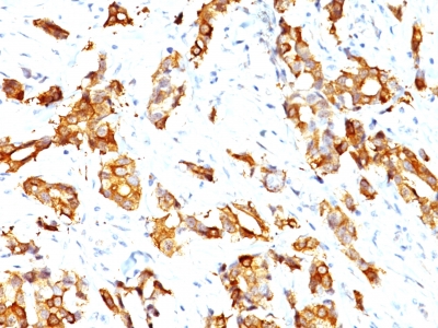 Formalin-fixed, paraffin-embedded human Prostate Carcinoma stained with HSP27 Monoclonal Antibody (HSPB1/774)