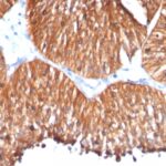 Formalin-fixed, paraffin-embedded human Lung Carcinoma stained with HSP6 Monoclonal Antibody (HSPD1/78)