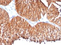 Formalin-fixed, paraffin-embedded human Lung Carcinoma stained with HSP6 Monoclonal Antibody (HSPD1/78)