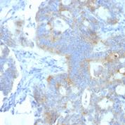 Formalin-fixed, paraffin-embedded human Testicular Carcinoma stained with Heparan Sulfate Monoclonal Antibody (A7L6).