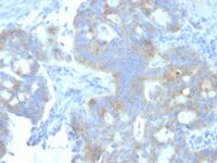 Formalin-fixed, paraffin-embedded human Testicular Carcinoma stained with Heparan Sulfate Monoclonal Antibody (A7L6).