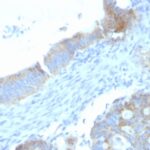 Formalin-fixed, paraffin-embedded human Testicular Carcinoma stained with Heparan Sulfate Monoclonal Antibody (SPM255).