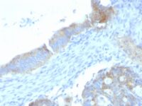 Formalin-fixed, paraffin-embedded human Testicular Carcinoma stained with Heparan Sulfate Monoclonal Antibody (SPM255).