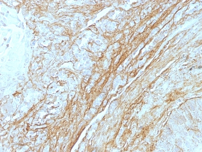 Formalin-fixed, paraffin-embedded human Lung Carcinoma stained with Tenascin C Monoclonal Antibody (T2H5) at 4ug/ml. Antigen retrieval in 1mM Tris with 1mM EDTA, pH 9.; ABC detection system with DAB Chromogen. Note staining of connective tissue.