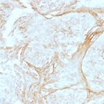 Formalin-fixed, paraffin-embedded human Lung Carcinoma stained with Tenascin C Monoclonal Antibody (SPM319) at 4ug/ml. Antigen retrieval in 1mM Tris with 1mM EDTA, pH 9.; ABC detection system with DAB Chromogen. Note staining of connective tissue.