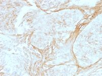 Formalin-fixed, paraffin-embedded human Lung Carcinoma stained with Tenascin C Monoclonal Antibody (SPM319) at 4ug/ml. Antigen retrieval in 1mM Tris with 1mM EDTA, pH 9.; ABC detection system with DAB Chromogen. Note staining of connective tissue.