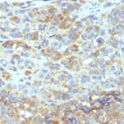 Formalin-fixed, paraffin-embedded human Melanoma stained with CD54 Monoclonal Antibody (W-CAM-1).