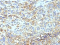 Formalin-fixed, paraffin-embedded human Melanoma stained with CD54 Monoclonal Antibody (W-CAM-1).