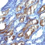 Formalin-fixed, paraffin-embedded human Testicular Carcinoma stained with Interferon gamma Monoclonal Antibody (IFNG/466)