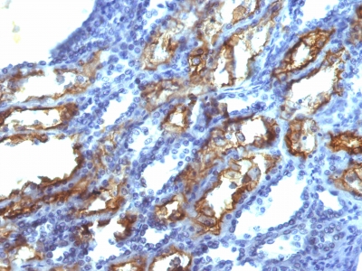 Formalin-fixed, paraffin-embedded human Testicular Carcinoma stained with Interferon gamma Monoclonal Antibody (IFNG/466)