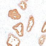 Formalin-fixed, paraffin-embedded human Prostate Carcinoma stained with PSA Monoclonal Antibody (A67-B/E3).