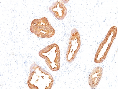 Formalin-fixed, paraffin-embedded human Prostate Carcinoma stained with PSA Monoclonal Antibody (A67-B/E3).