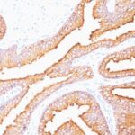 Formalin-fixed, paraffin-embedded human Prostate Carcinoma stained with PSA Monoclonal Antibody (SPM352).