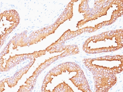 Formalin-fixed, paraffin-embedded human Prostate Carcinoma stained with PSA Monoclonal Antibody (SPM352).