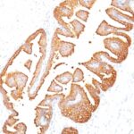 Formalin-fixed, paraffin-embedded human Prostate Carcinoma stained with PSA Monoclonal Antibody (KLK3/81).