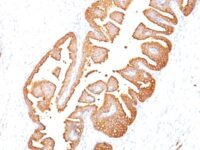 Formalin-fixed, paraffin-embedded human Prostate Carcinoma stained with PSA Monoclonal Antibody (KLK3/81).