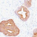 Formalin-fixed, paraffin-embedded human Prostate Carcinoma stained with PSA Monoclonal Antibody (1A7).