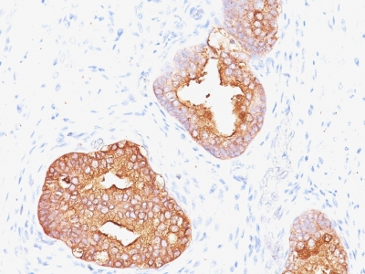 Formalin-fixed, paraffin-embedded human Prostate Carcinoma stained with PSA Monoclonal Antibody (1A7).