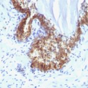 Formalin-fixed, paraffin-embedded human Prostate Carcinoma stained with PSA Monoclonal Antibody (KLK3/1248).