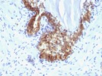 Formalin-fixed, paraffin-embedded human Prostate Carcinoma stained with PSA Monoclonal Antibody (KLK3/1248).