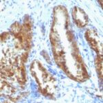 Formalin-fixed, paraffin-embedded human Prostate Carcinoma stained with PSA Monoclonal Antibody (A67-B/E3 + 1A7).