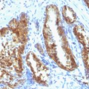 Formalin-fixed, paraffin-embedded human Prostate Carcinoma stained with PSA Monoclonal Antibody (A67-B/E3 + 1A7).