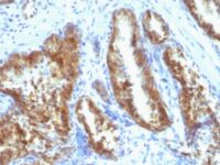 Formalin-fixed, paraffin-embedded human Prostate Carcinoma stained with PSA Monoclonal Antibody (A67-B/E3 + 1A7).