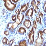 Formalin-fixed, paraffin-embedded human Prostate Carcinoma stained with PSA Monoclonal Antibody (KLK3/81 + KLK3/1248).