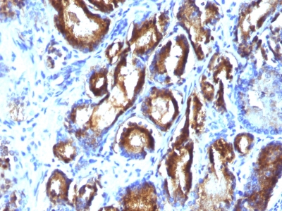 Formalin-fixed, paraffin-embedded human Prostate Carcinoma stained with PSA Monoclonal Antibody (KLK3/81 + KLK3/1248).