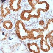 Formalin-fixed, paraffin-embedded human Colon Carcinoma stained with IL-6 Monoclonal Antibody (IL6/127).