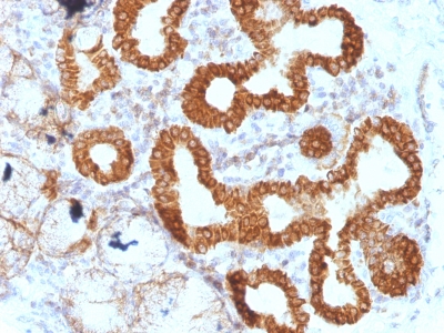 Formalin-fixed, paraffin-embedded human Colon Carcinoma stained with IL-6 Monoclonal Antibody (IL6/127).