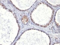 Formalin-paraffin human Prostate Carcinoma stained with Androgen Receptor Monoclonal Antibody (AR441).