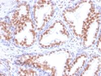 Formalin-paraffin human Prostate Adenocarcinoma stained with Androgen Receptor Monoclonal Antibody (DHTR/882).