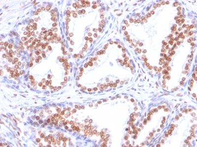 Formalin-paraffin human Prostate Adenocarcinoma stained with Androgen Receptor Monoclonal Antibody (DHTR/882).