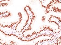 Formalin-fixed, paraffin-embedded human prostate carcinoma stained with Androgen Receptor Monoclonal Antibody (AR441 + DHTR/882).