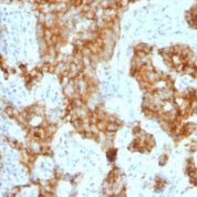 Formalin-fixed, paraffin-embedded human Lung Carcinoma stained with CD11c Monoclonal Antibody (ITGAX/1243) at 1ug/ml. Antigen retrieval in 1mM Tris with 1mM EDTA, pH 9.; ABC detection system with DAB Chromogen. Note staining of Lung cancer cells.