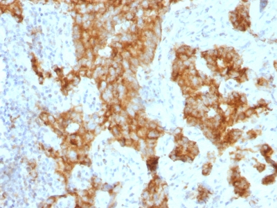 Formalin-fixed, paraffin-embedded human Lung Carcinoma stained with CD11c Monoclonal Antibody (ITGAX/1243) at 1ug/ml. Antigen retrieval in 1mM Tris with 1mM EDTA, pH 9.; ABC detection system with DAB Chromogen. Note staining of Lung cancer cells.