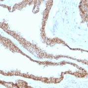Formalin-fixed, paraffin-embedded human Cervical Carcinoma stained with Catenin, gamma Monoclonal Antibody (CTNG/1664)