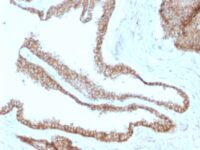 Formalin-fixed, paraffin-embedded human Cervical Carcinoma stained with Catenin, gamma Monoclonal Antibody (CTNG/1664)