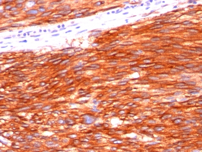 Formalin-fixed, paraffin-embedded human Gastrointestinal Stromal Tumor (GIST) stained with CD117 Monoclonal Antibody (C117/37).