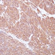 Formalin-fixed, paraffin-embedded human Gastrointestinal Stromal Tumor (GIST) stained with CD117 Monoclonal Antibody (C117/37 + KIT/982 + KIT/983).