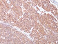 Formalin-fixed, paraffin-embedded human Gastrointestinal Stromal Tumor (GIST) stained with CD117 Monoclonal Antibody (C117/37 + KIT/982 + KIT/983).