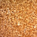 Formalin-fixed, paraffin-embedded human Hepatocellular Carcinoma stained with ARG1 Monoclonal Antibody (ARG1/1126).