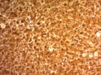 Formalin-fixed, paraffin-embedded human Hepatocellular Carcinoma stained with ARG1 Monoclonal Antibody (ARG1/1126).